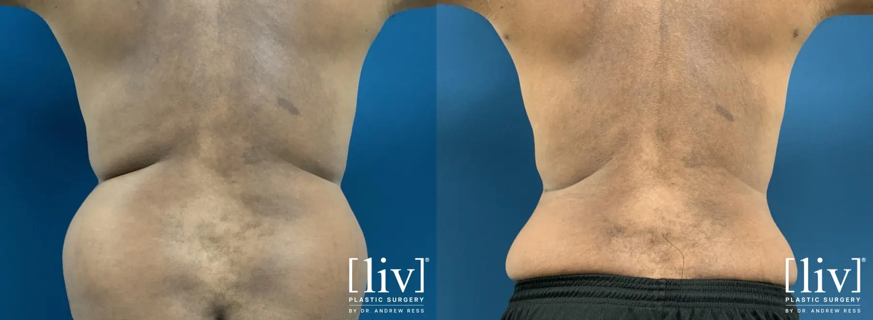 Liposuction: Patient 48 - Before and After 1