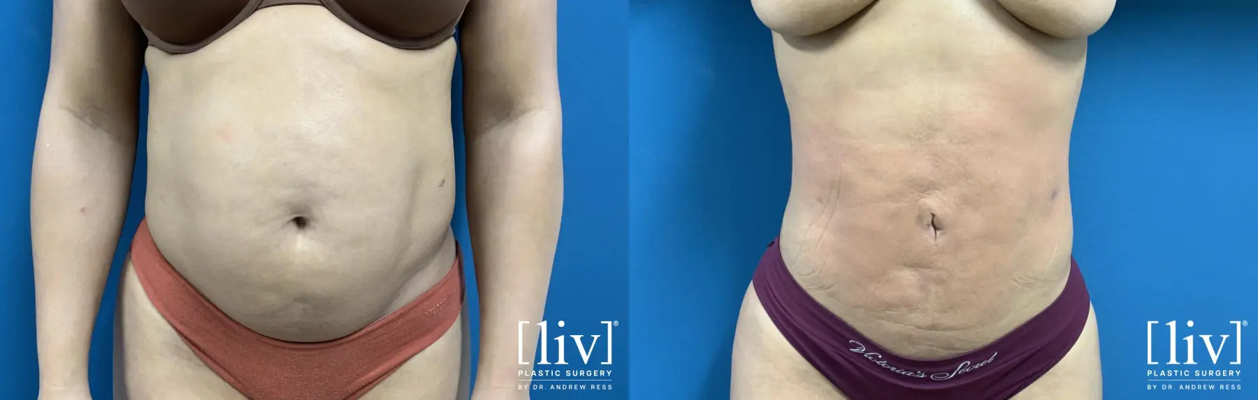 Liposuction: Patient 37 - Before and After 3