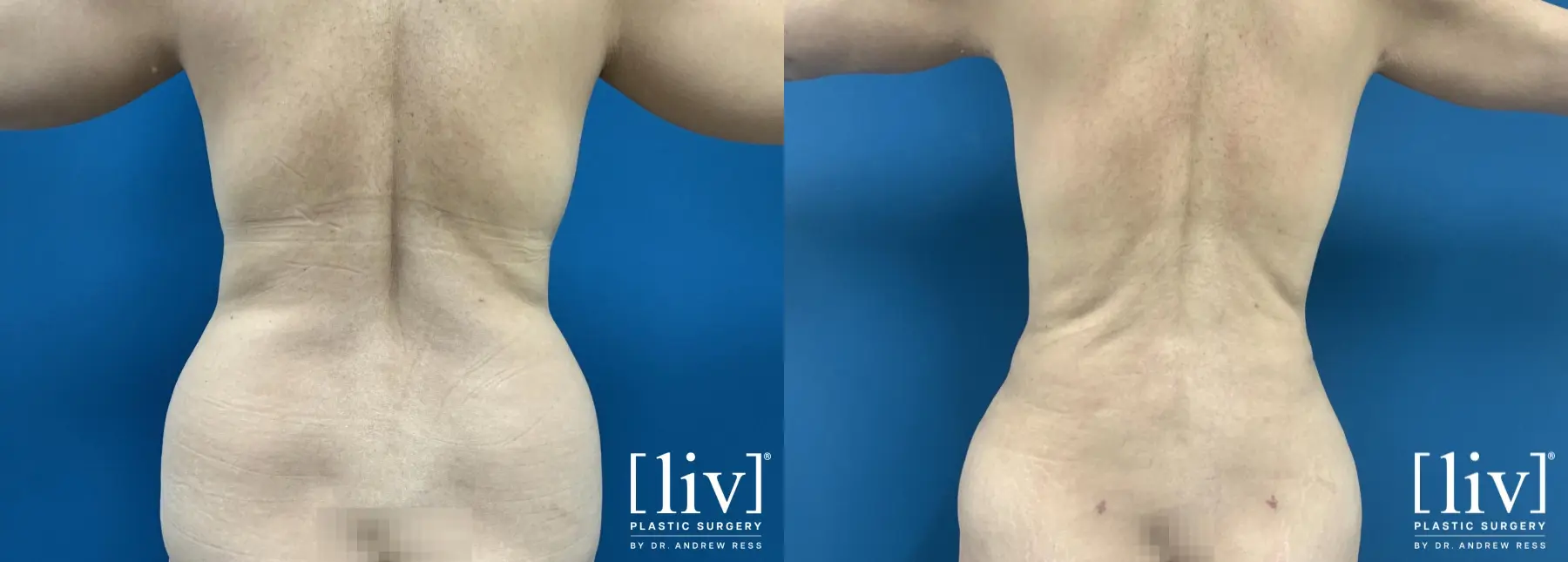 Liposuction: Patient 13 - Before and After 4