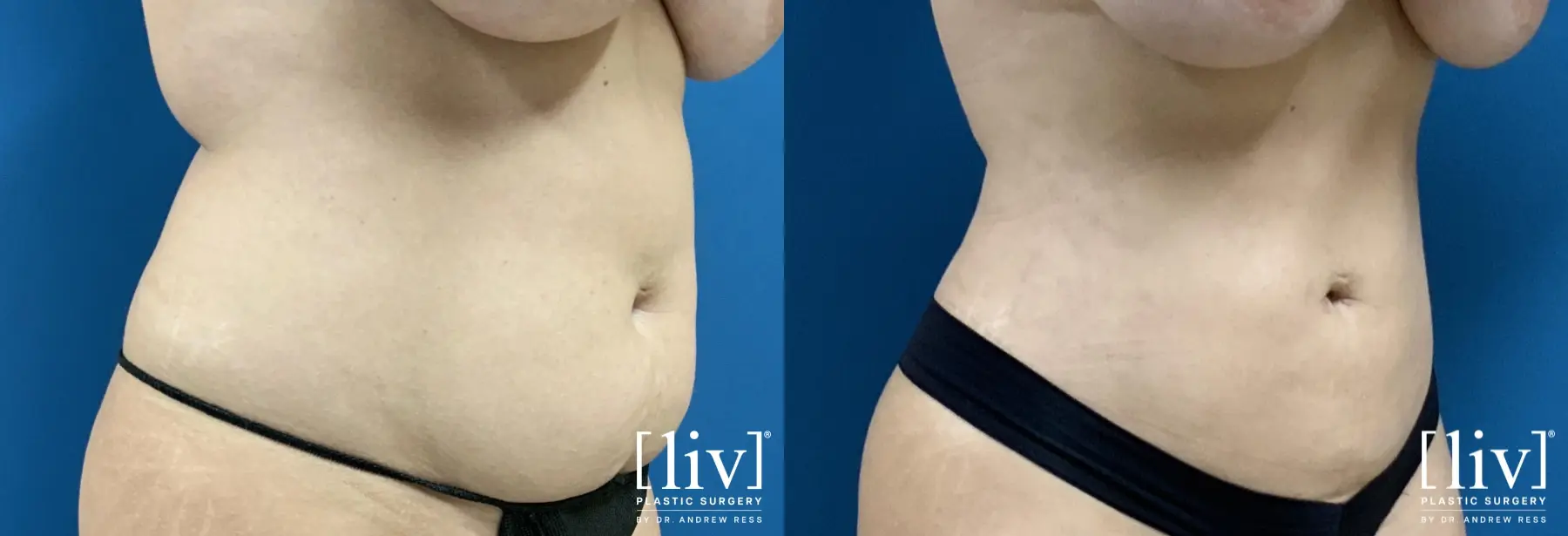 Liposuction: Patient 29 - Before and After 4