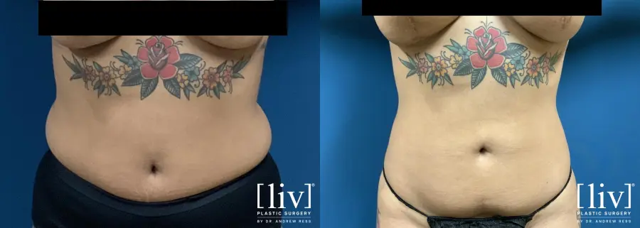 Liposuction: Patient 10 - Before and After 1