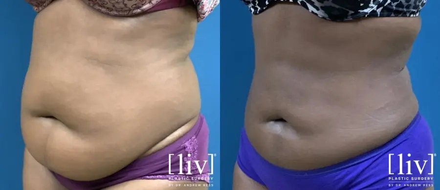 Liposuction: Patient 11 - Before and After 4