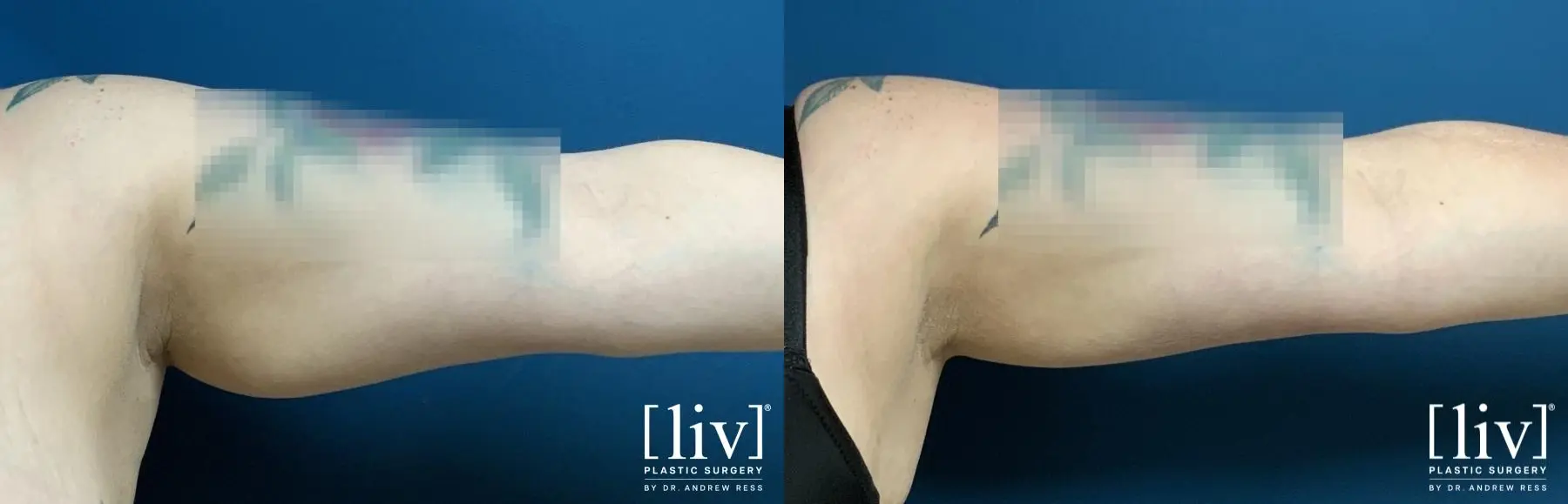 Arm Liposuction - Before and After 2