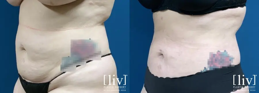 Liposuction: Patient 9 - Before and After 4