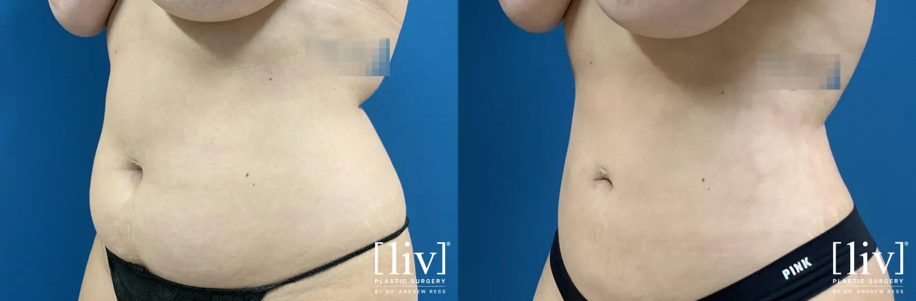 Liposuction: Patient 29 - Before and After 2