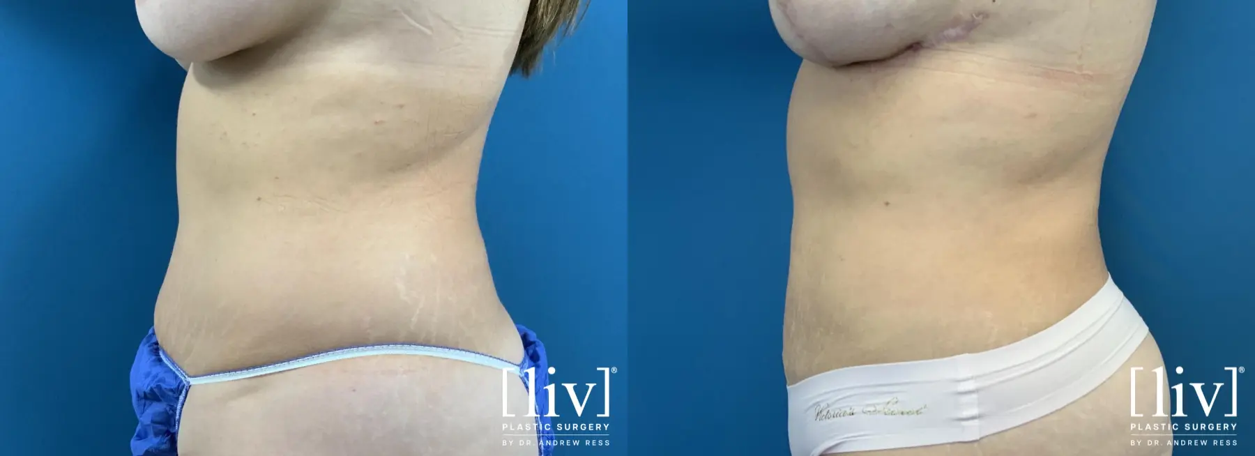 Liposuction: Patient 38 - Before and After 2