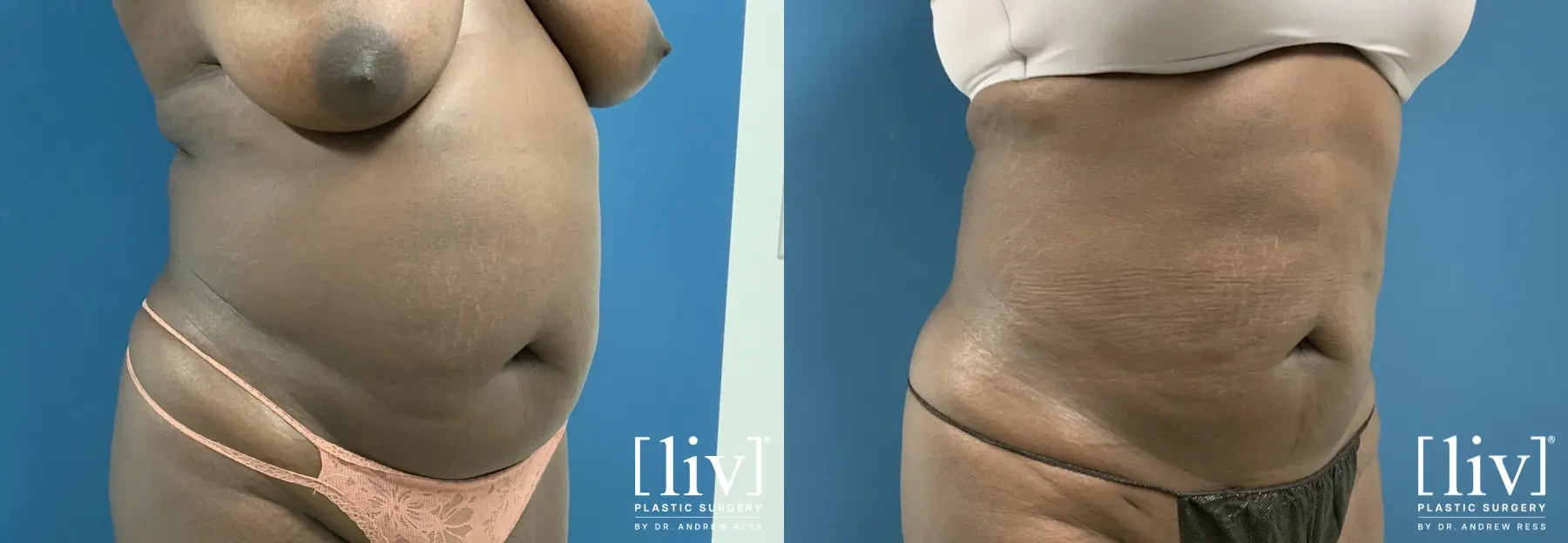 Liposuction: Patient 34 - Before and After 2