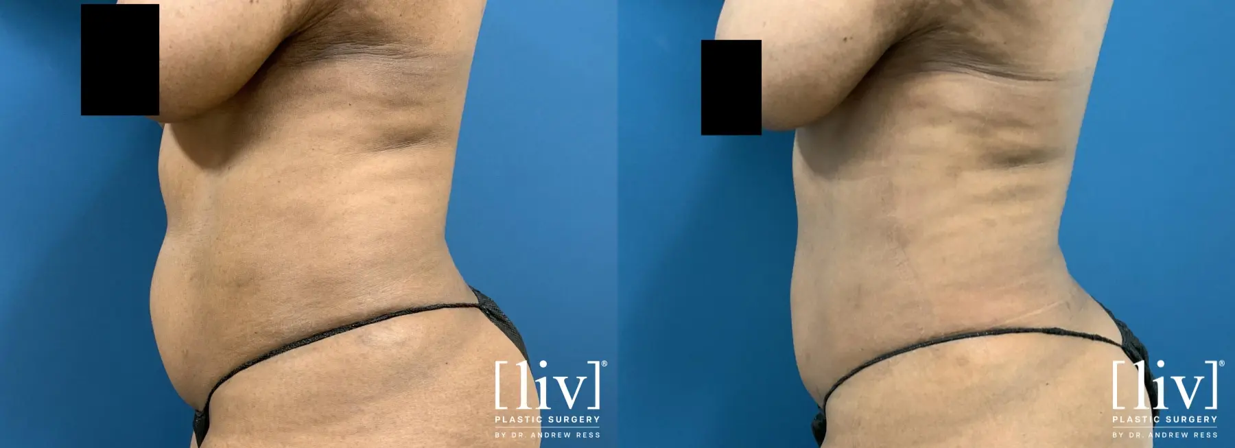 Liposuction: Patient 33 - Before and After 1