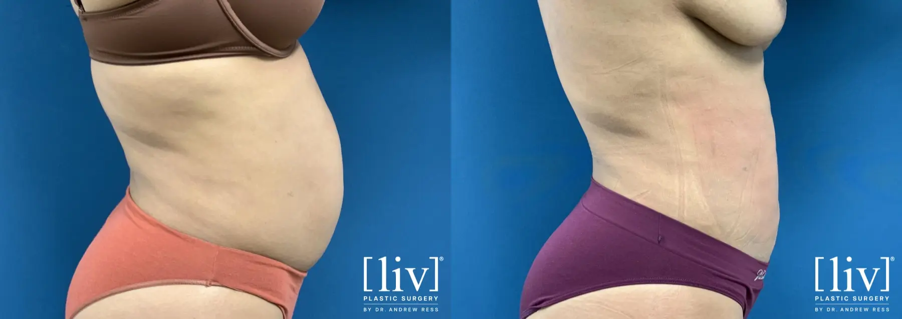 Liposuction: Patient 37 - Before and After 1