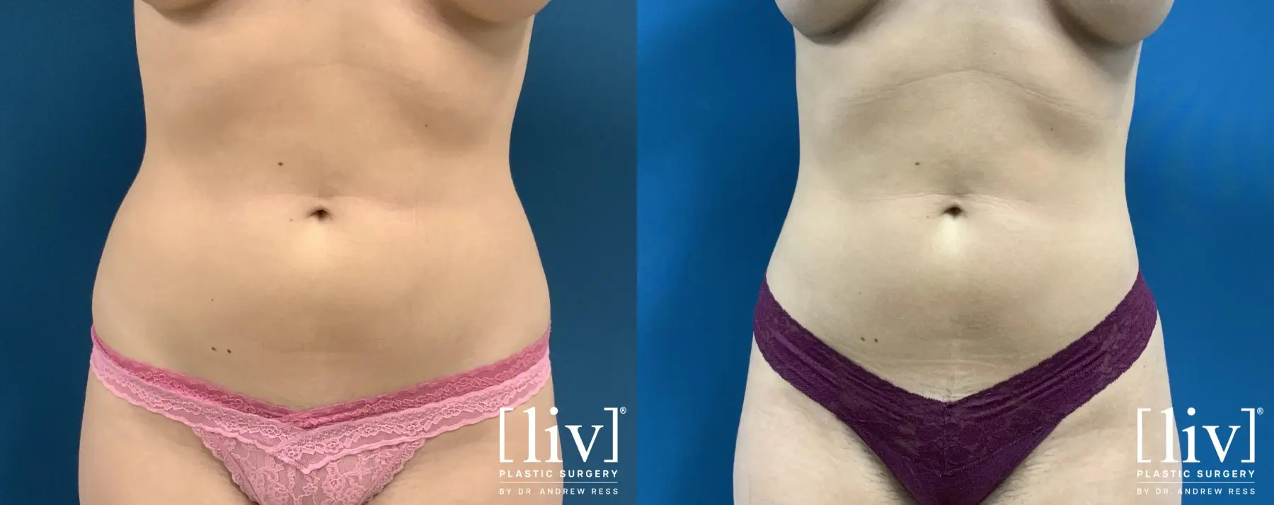 Liposuction: Patient 41 - Before and After 2