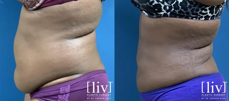 Liposuction: Patient 7 - Before and After 5