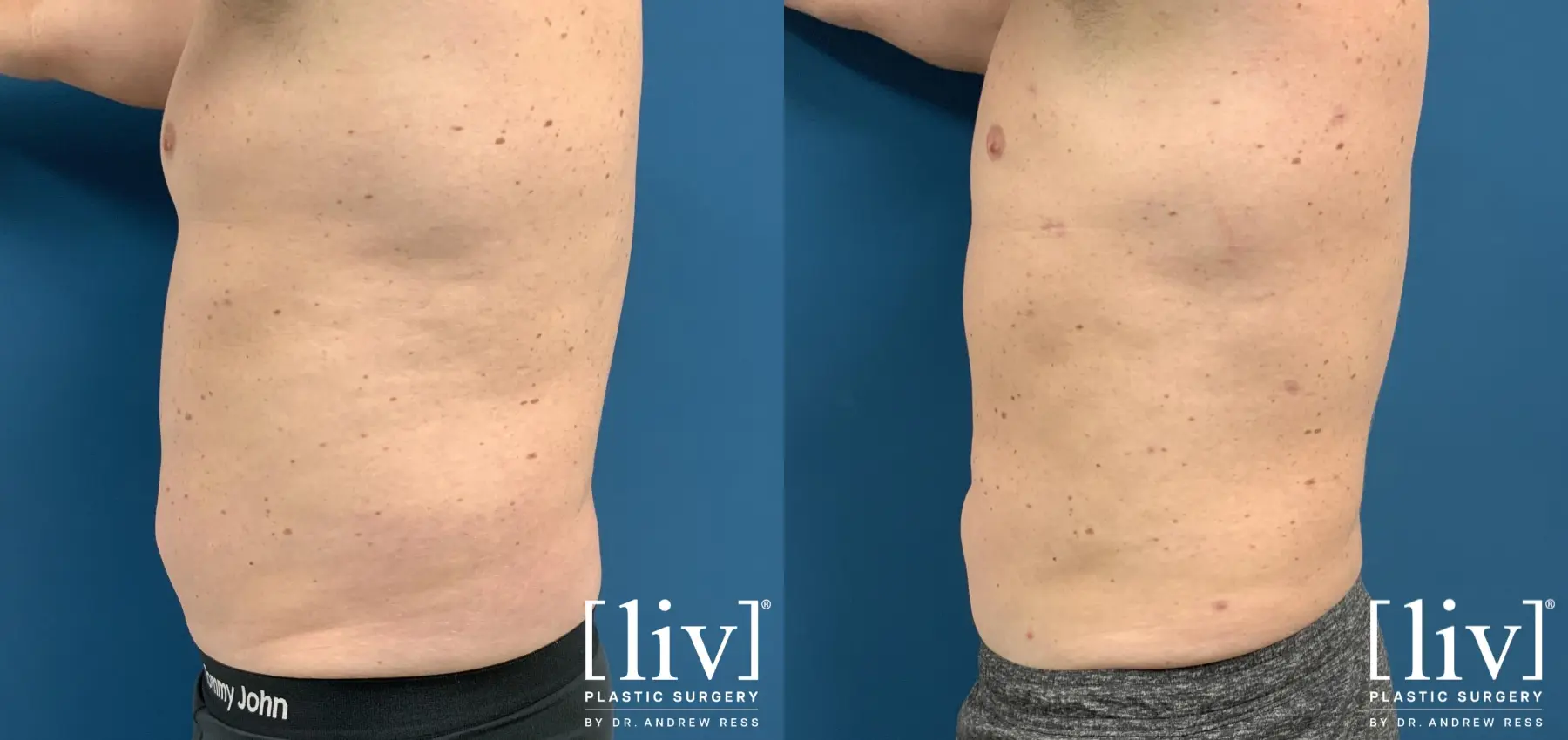 Men Liposuction - Before and After 3