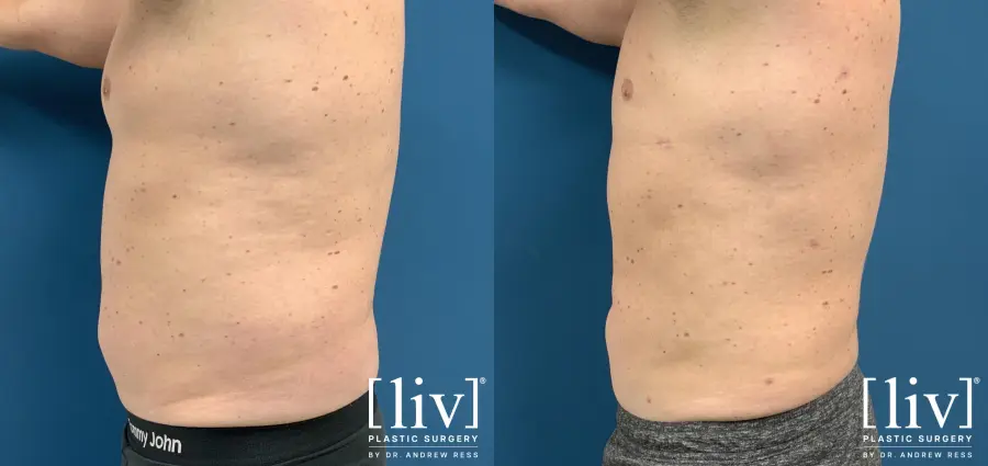 Men Vaser Liposuction - Before and After 3