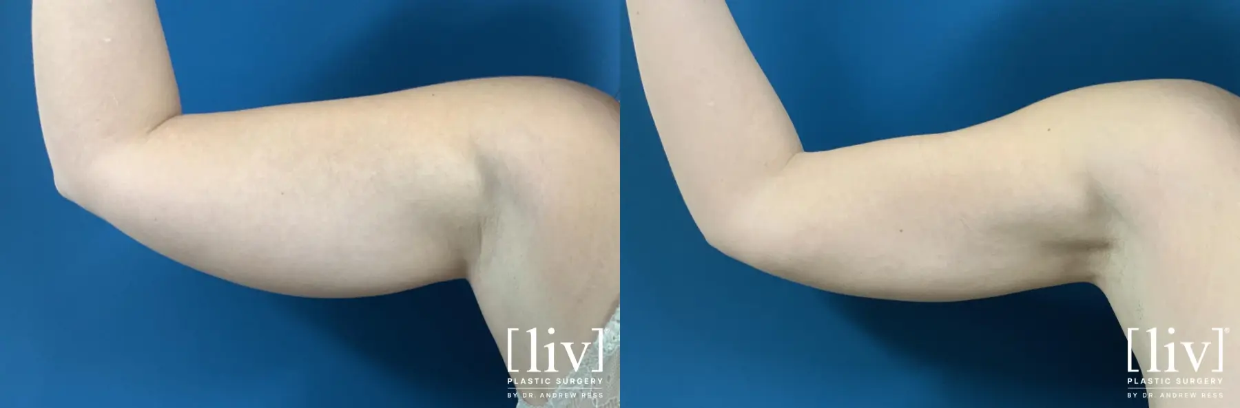 Arm Liposuction - Before and After 1