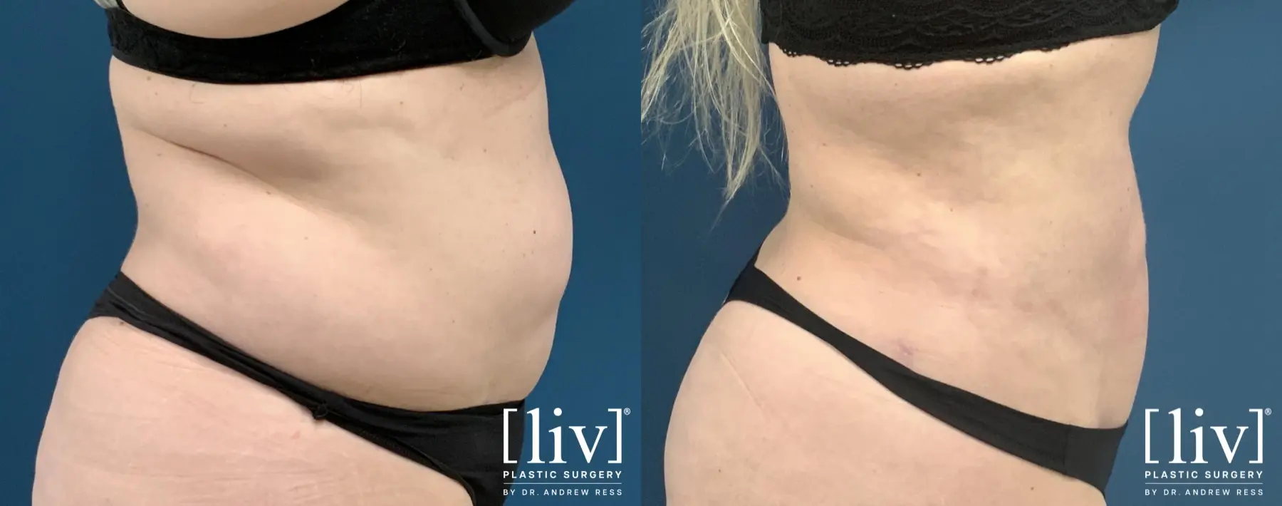Liposuction: Patient 47 - Before and After 2