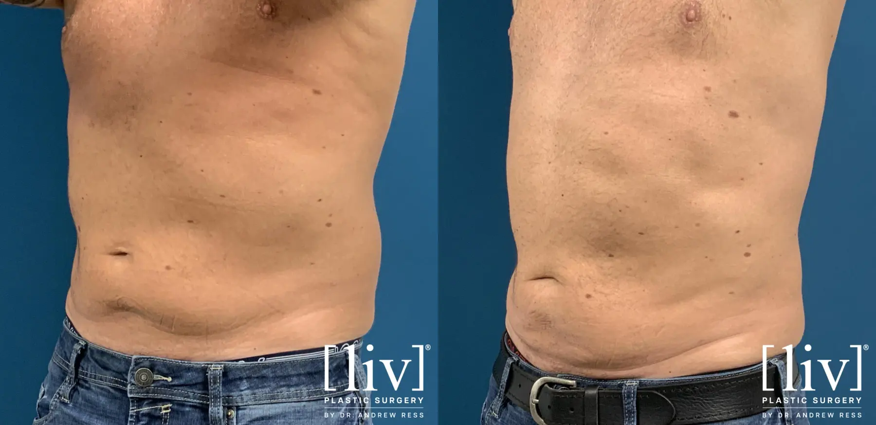 Men Liposuction - Before and After 2