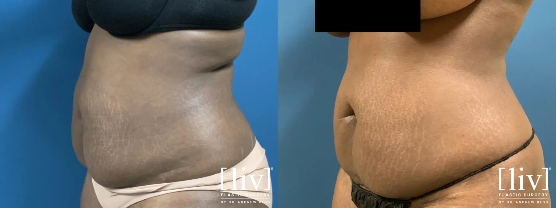 Liposuction: Patient 19 - Before and After 3
