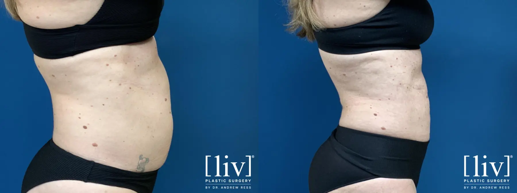 Liposuction: Patient 6 - Before and After  