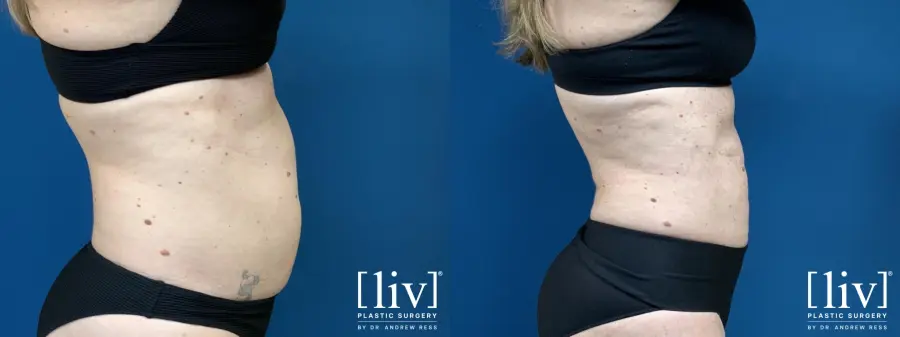 Liposuction: Patient 6 - Before and After 1