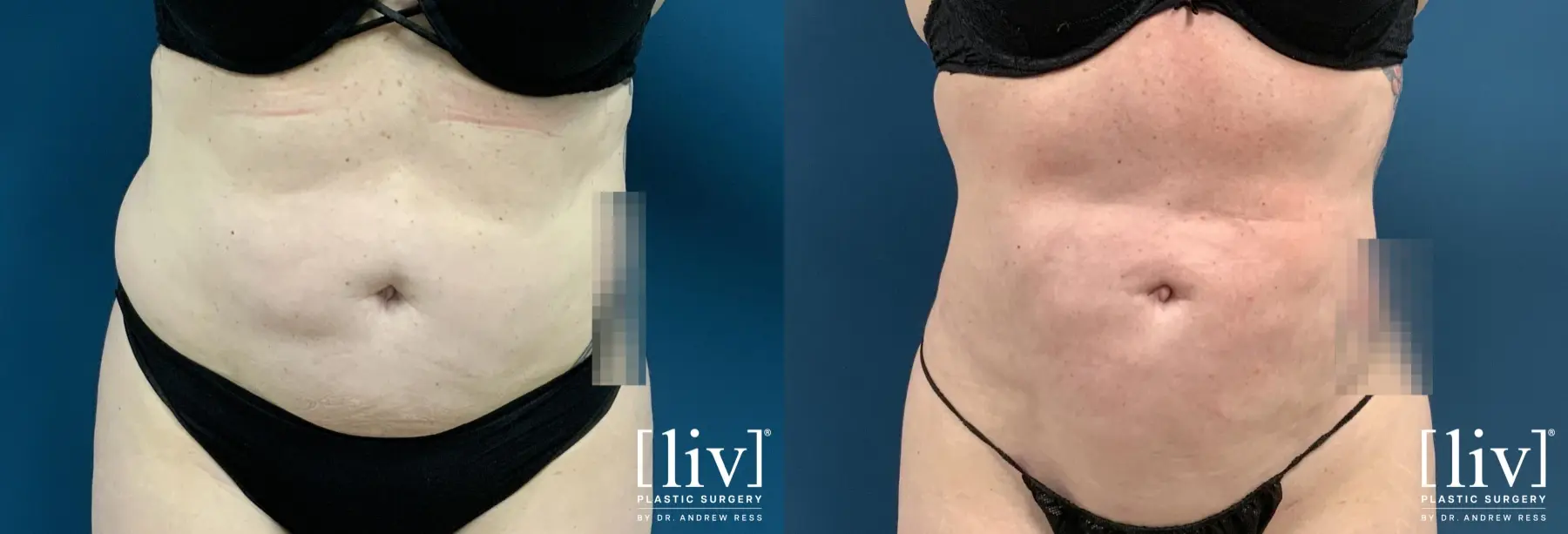 Liposuction: Patient 45 - Before and After 1