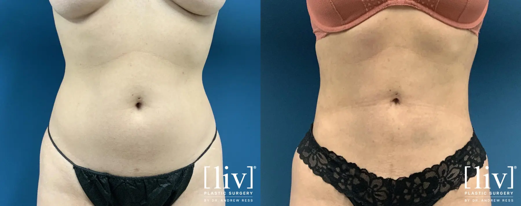 Liposuction: Patient 44 - Before and After 1