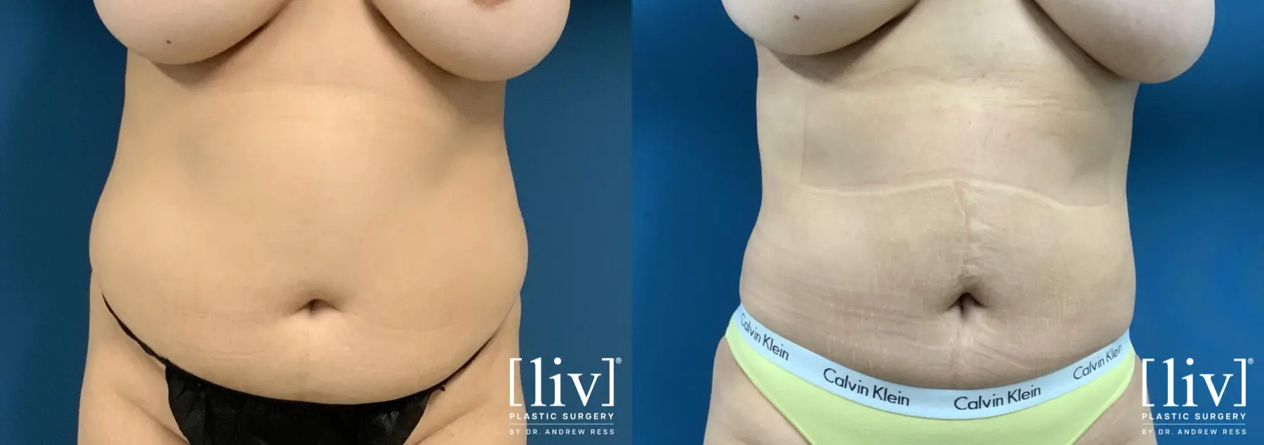 Liposuction: Patient 41 - Before and After 3