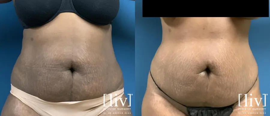 Liposuction: Patient 17 - Before and After 4