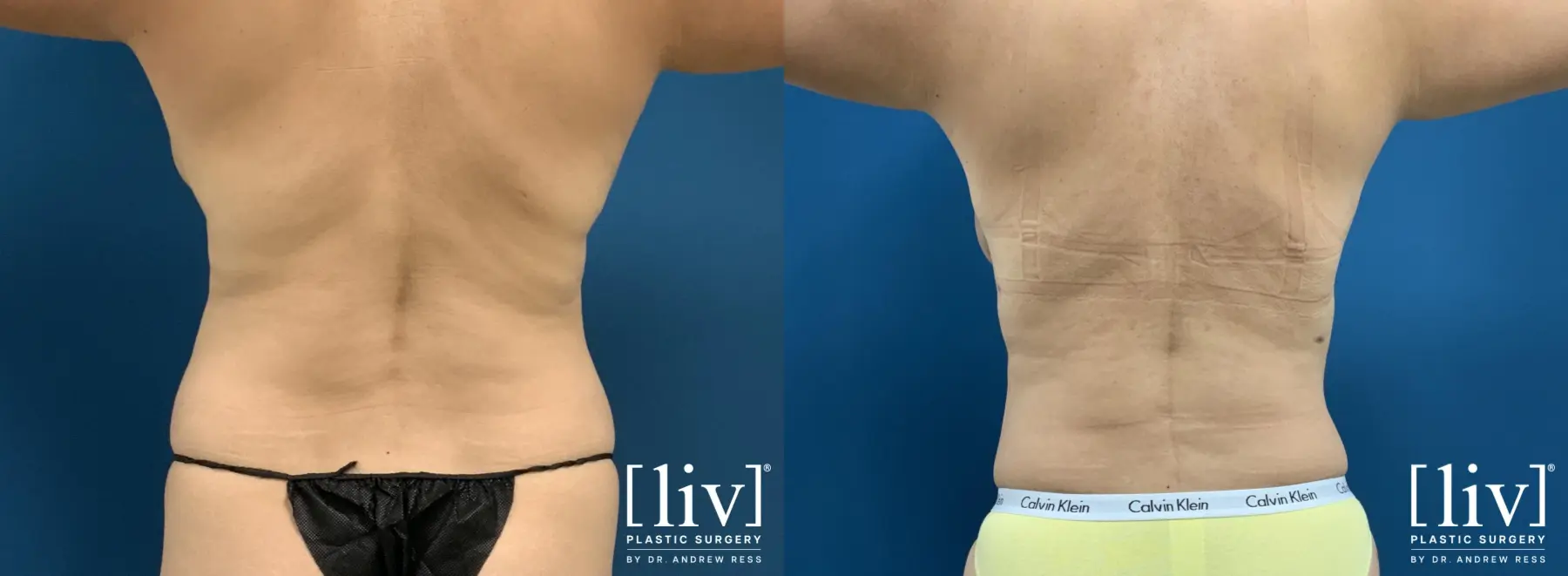 Liposuction: Patient 41 - Before and After 7