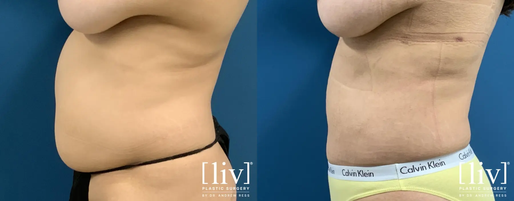 Liposuction: Patient 43 - Before and After 1
