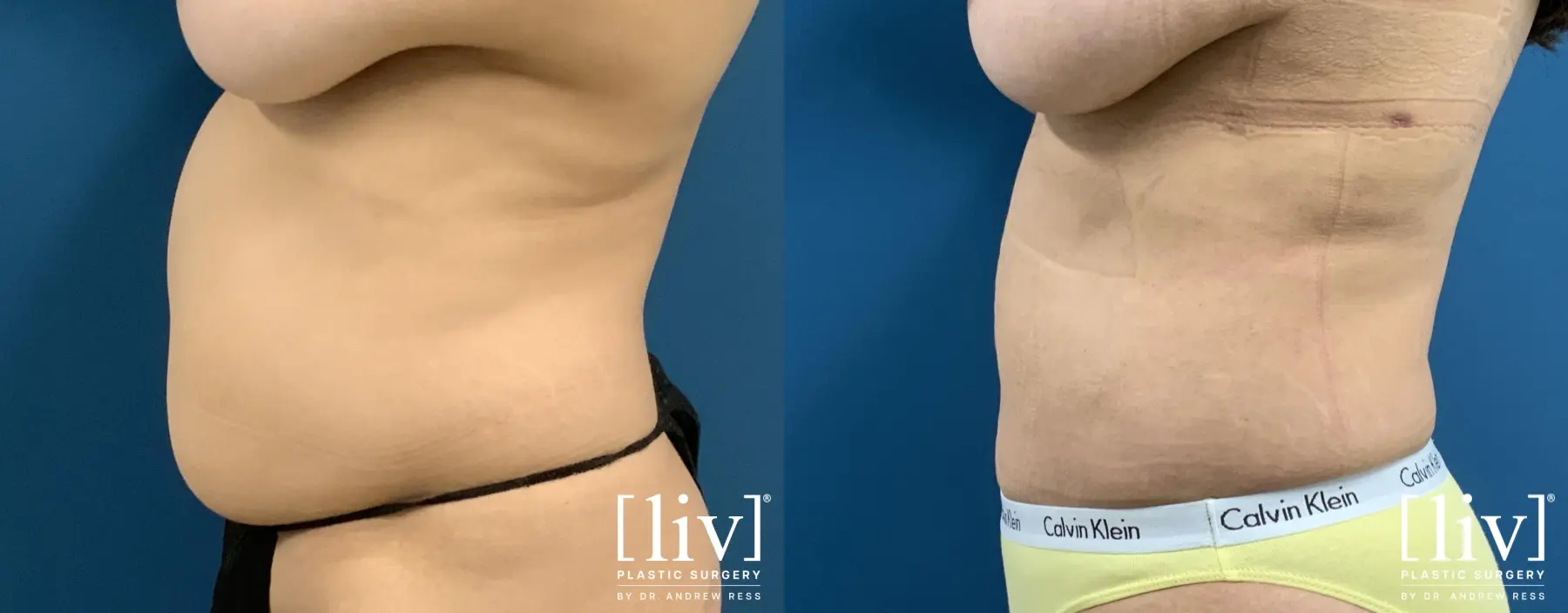 Liposuction: Patient 41 - Before and After 1