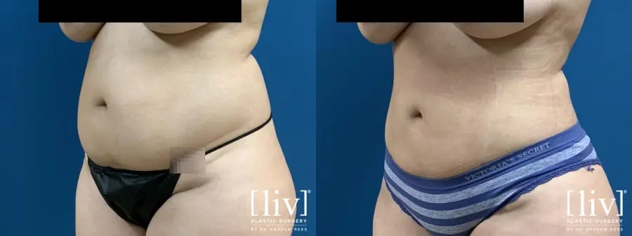 Liposuction: Patient 8 - Before and After 2