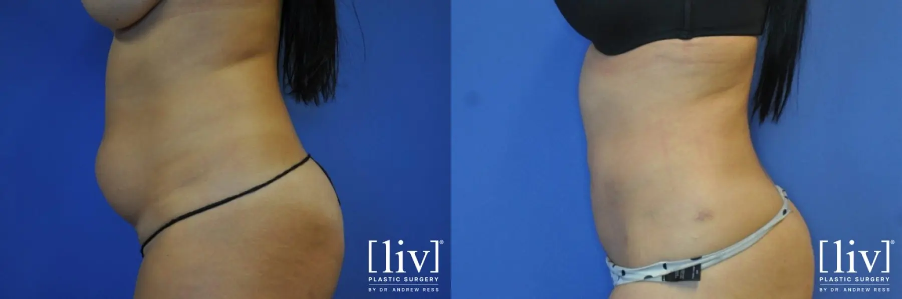 Liposuction: Patient 4 - Before and After 1