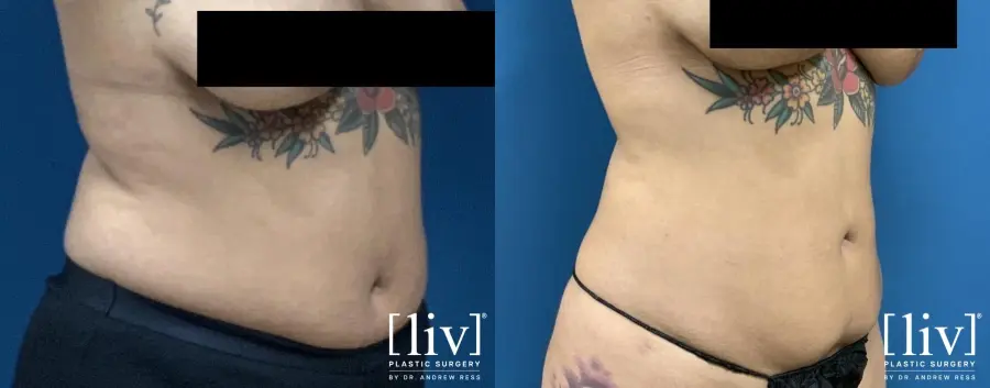 Liposuction: Patient 6 - Before and After 4