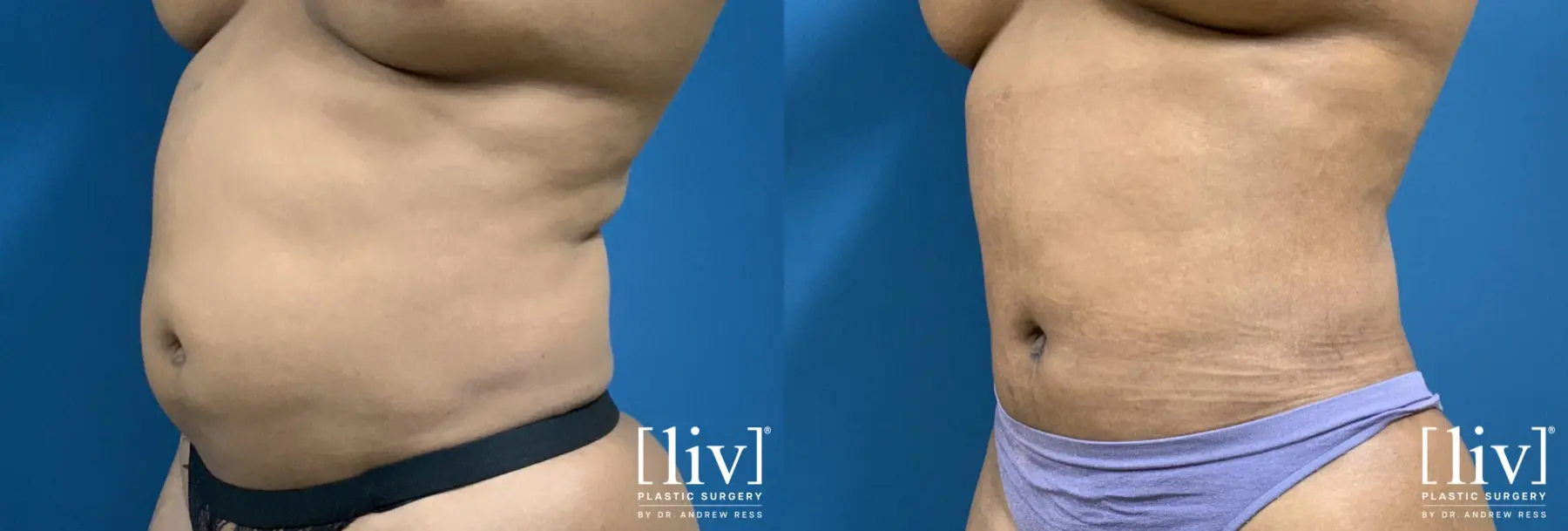 Liposuction: Patient 26 - Before and After 2
