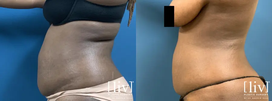 Liposuction: Patient 17 - Before and After 2
