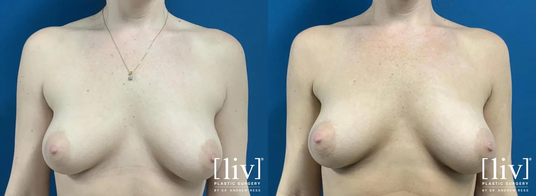 Bra-Fat Liposuction - Before and After 1