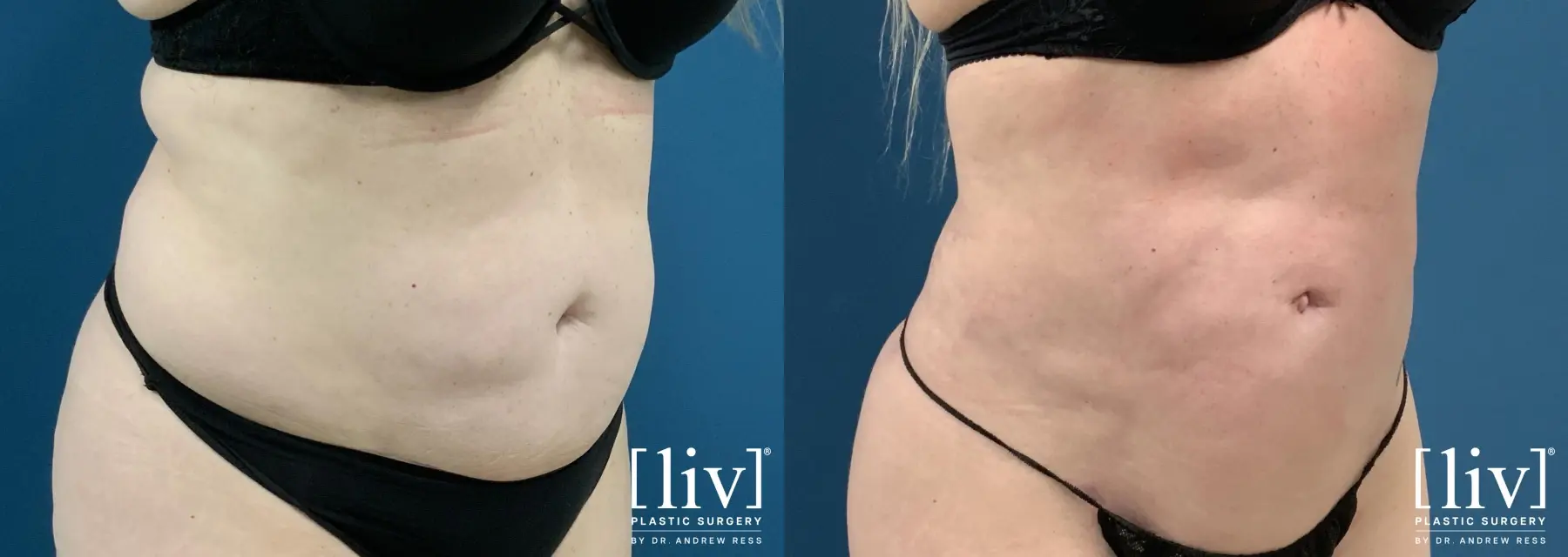 Liposuction: Patient 45 - Before and After 2