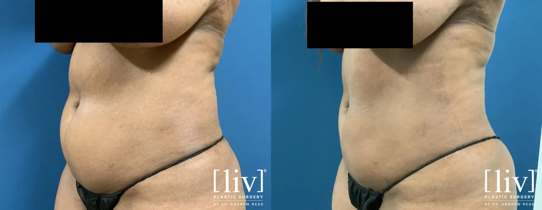 Liposuction: Patient 33 - Before and After 2