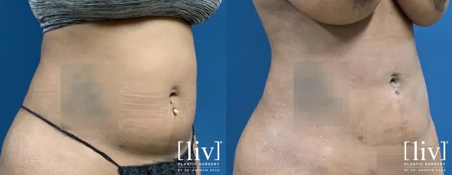 Liposuction: Patient 1 - Before and After 4