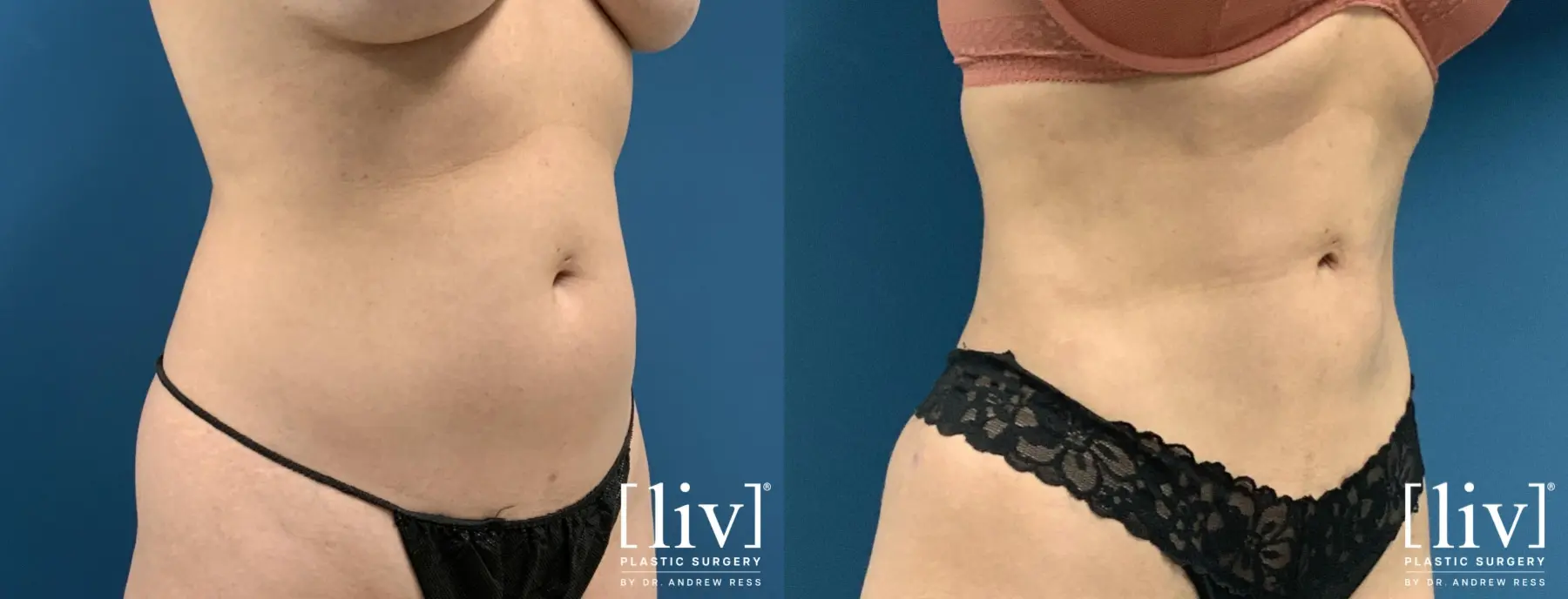 Liposuction: Patient 44 - Before and After 2