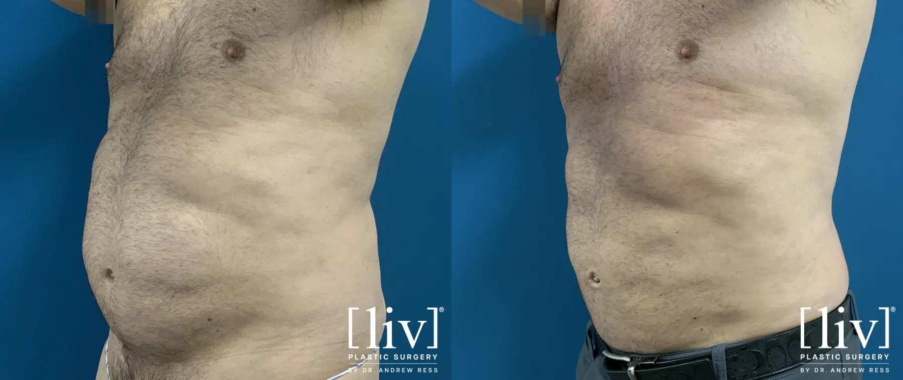 Men Liposuction - Before and After 2
