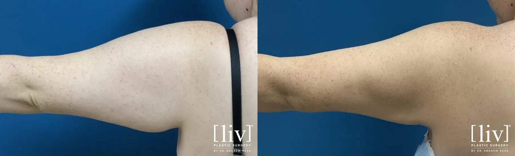 Arm Liposuction - Before and After 3