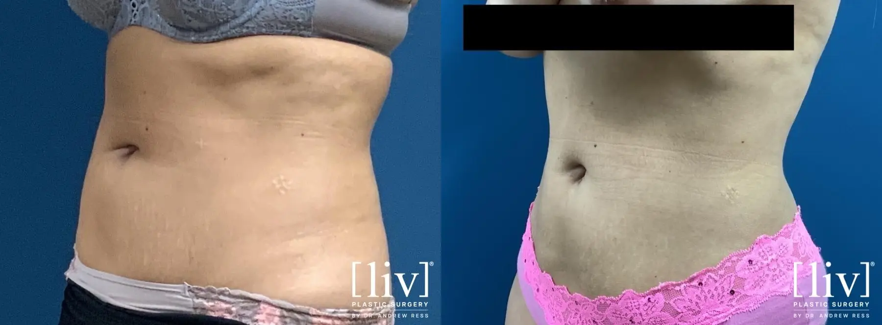 Liposuction: Patient 2 - Before and After 2