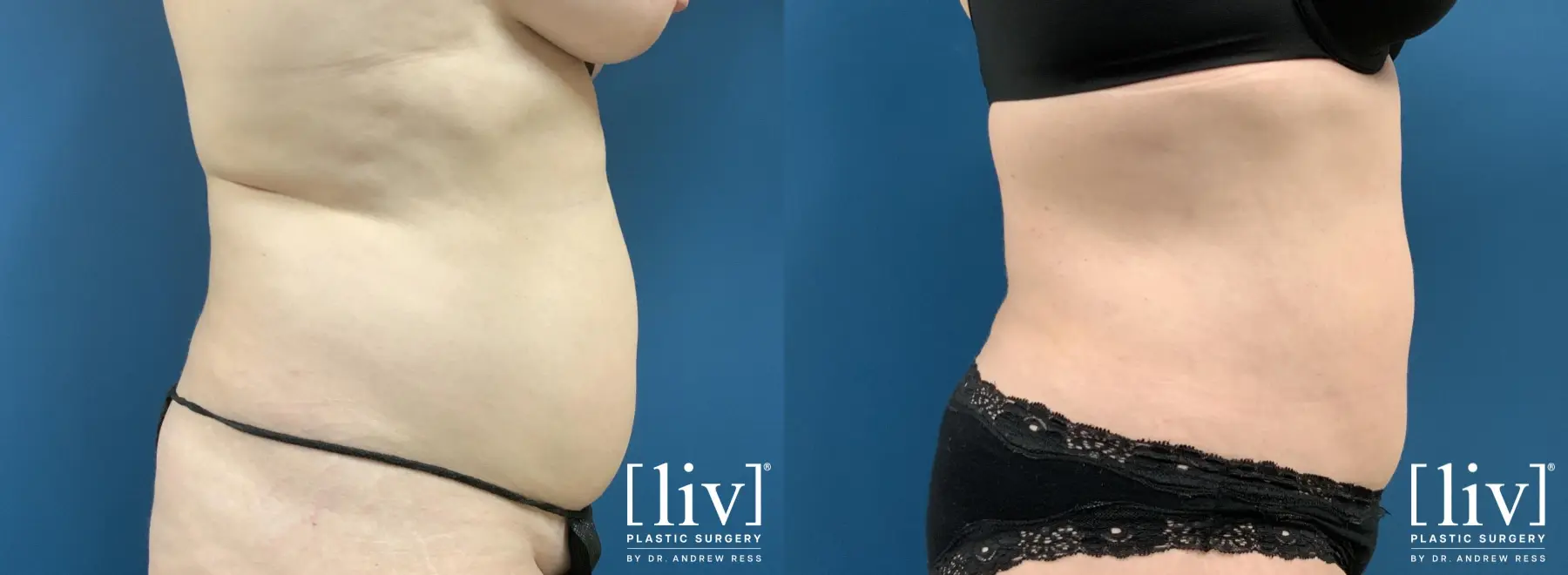 Liposuction: Patient 30 - Before and After 3