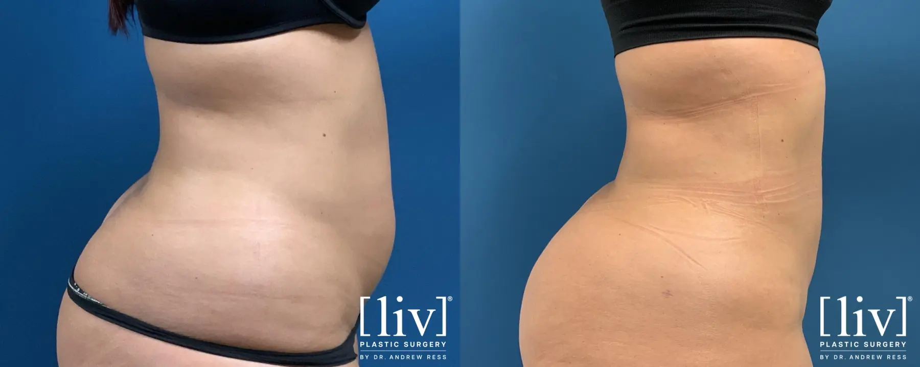 Liposuction: Patient 7 - Before and After 1