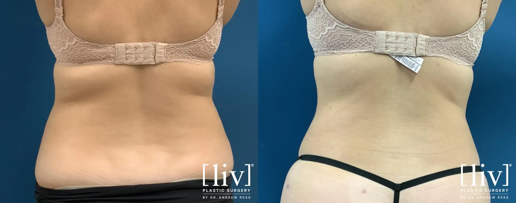 Liposuction: Patient 49 - Before and After 4