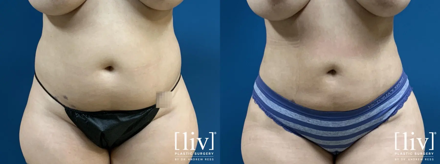 Liposuction: Patient 14 - Before and After 1