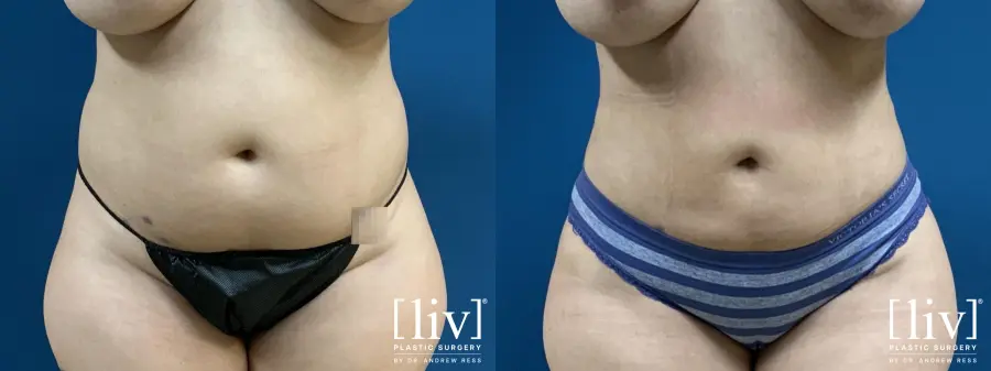 Liposuction: Patient 8 - Before and After 1