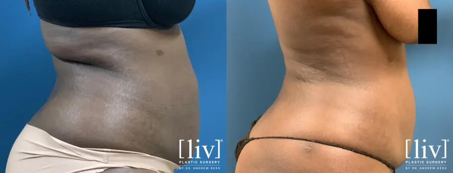 Liposuction: Patient 17 - Before and After 6