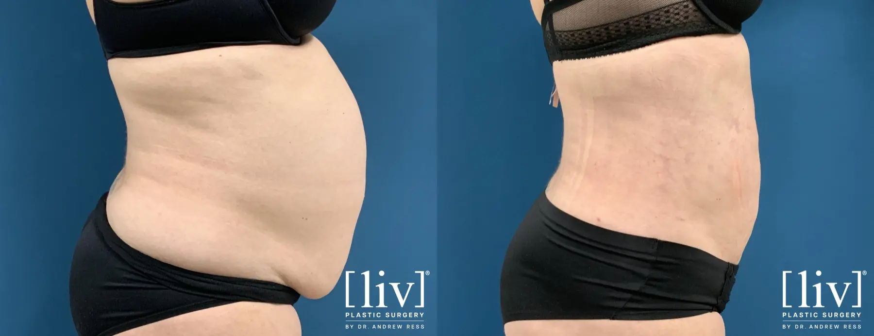 Liposuction: Patient 35 - Before and After 5